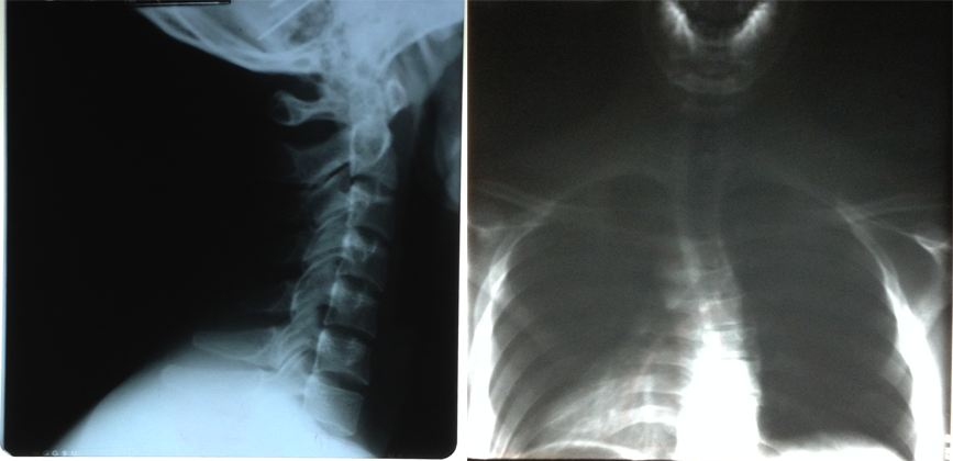 Scoliosis Sucks but It’s Still No Excuse